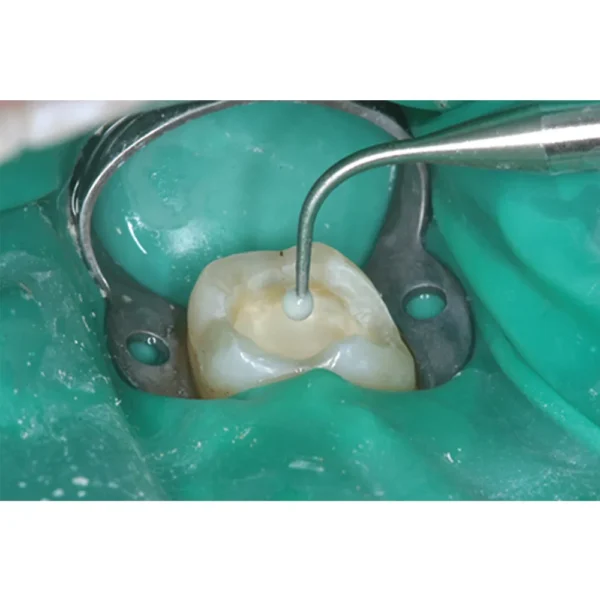 GDC Dental Dycal Applicator-Double Ended-1 (PICH6)
